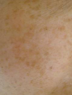 ディープポアクレンジングセラピー「Isolaz」