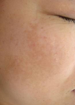 肝斑(かんぱん)とは:両頬、額、下顎、上口唇(鼻の下)に左右対称に出るシミです