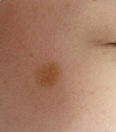 シミ、ホクロその他の良性腫瘍にお悩みの方へ。