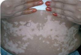 白斑(はくはん)とは?