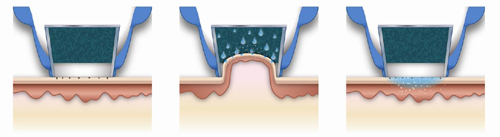浸透&リリース 浸透&リリース