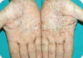 掌蹠膿疱症(しょうせきのうほうしょう)とは?